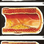 degenerazione aterosclerosi