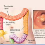 descrizione del tratto colon-rettale e colonscopia che rivela una crescita cancerosa