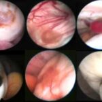 Endometriosi pelvica, da molte sconosciuta