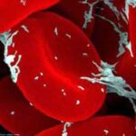 hemophilie