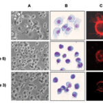 linfoblast