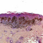 Melanoma