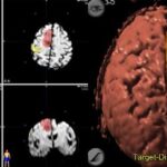 neuronavigatore