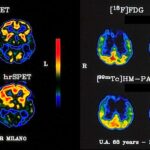 Immagini tomografiche PET (metabolismo di glucosio) e SPECT (perfusione) a due diversi livelli in un paziente affetto da malattia di Alzheimer (sinistra) e in un paziente con demenza frontotemporale (destra)