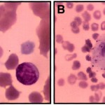 anemia-diseritropoietica