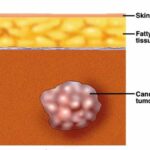 Localizzazione massa cancerosa: primo step termoablazione a radiofrequenza