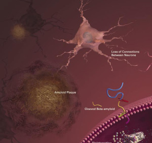 Alzheimer Plaques 300x281 Alzheimer: la caffeina è in grado di ridurre i livelli di beta amiloide