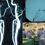 Brain Bypass