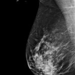 Digital mammography