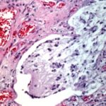 bronchi di un adulto colpiti da fibrosi cistica