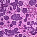cellule_cancerose_carcinoma_merkel