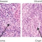 crohn