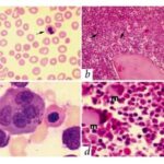 dyserythropoietic anemia