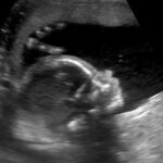 fetus
