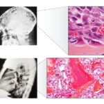 metastasi ossee, localizzate e ingrandite