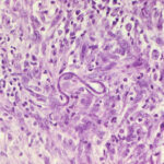 oncocercosi