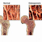 osteoporosi