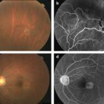 aberrazione periferica sulla retina
