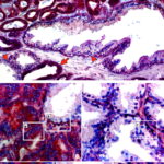 Tessuto prostatico con focolai cancerosi, ingranditi in basso