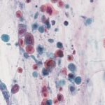 Non-small cell lung carcinoma