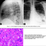 adenocarcinoma
