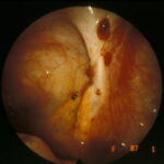 endometriosi