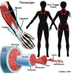 fibromialgia