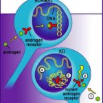 diagramma malattia di Kennedy