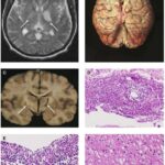 meningite