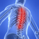 spondilitis