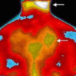 Fibromialgia