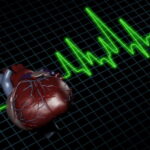 Myocardial-Infarction