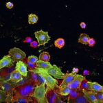 Cellule del cancro al colon (dal Daily Mail)