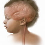 diseases-meningitis