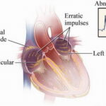 fibrillazione atriale