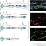 multiple_sclerosis