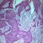 oral_carcinoma_cell