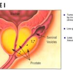 prostate_stage