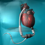 Ventricular assist device