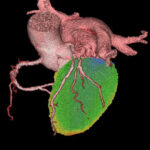 3d_miocardio