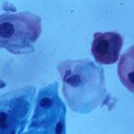 HPV