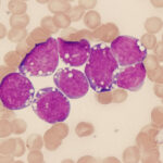Linfoma