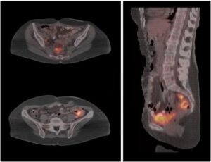 ovarian case 300x230 Tessuto ovarico trapiantato in addome: donna dopo un cancro, rimane incinta