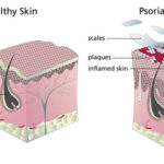 comparazione pelle sana e pelle con psoriasi
