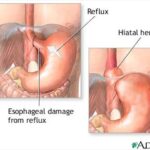 reflusso gastroesofageo