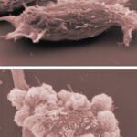 cellule del melanoma: in alto benigno, in basso invece maligno