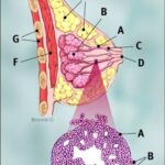 invasive_ductal_carcinoma