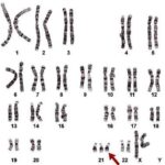 trisomia 21