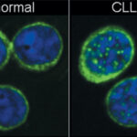 cellule_leucemia
