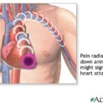 ecco come si propaga uno dei sintomi di attacco cardiaco